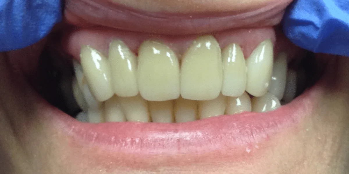After photo for crown case 4 smile transformation