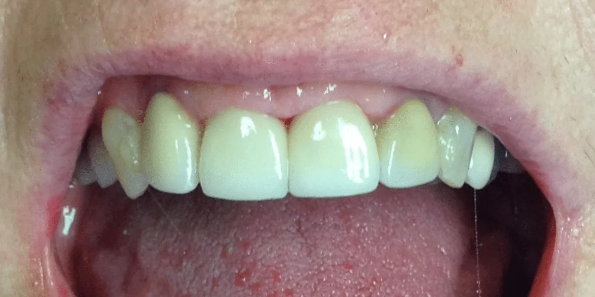 After photo for crown case 6 smile transformation