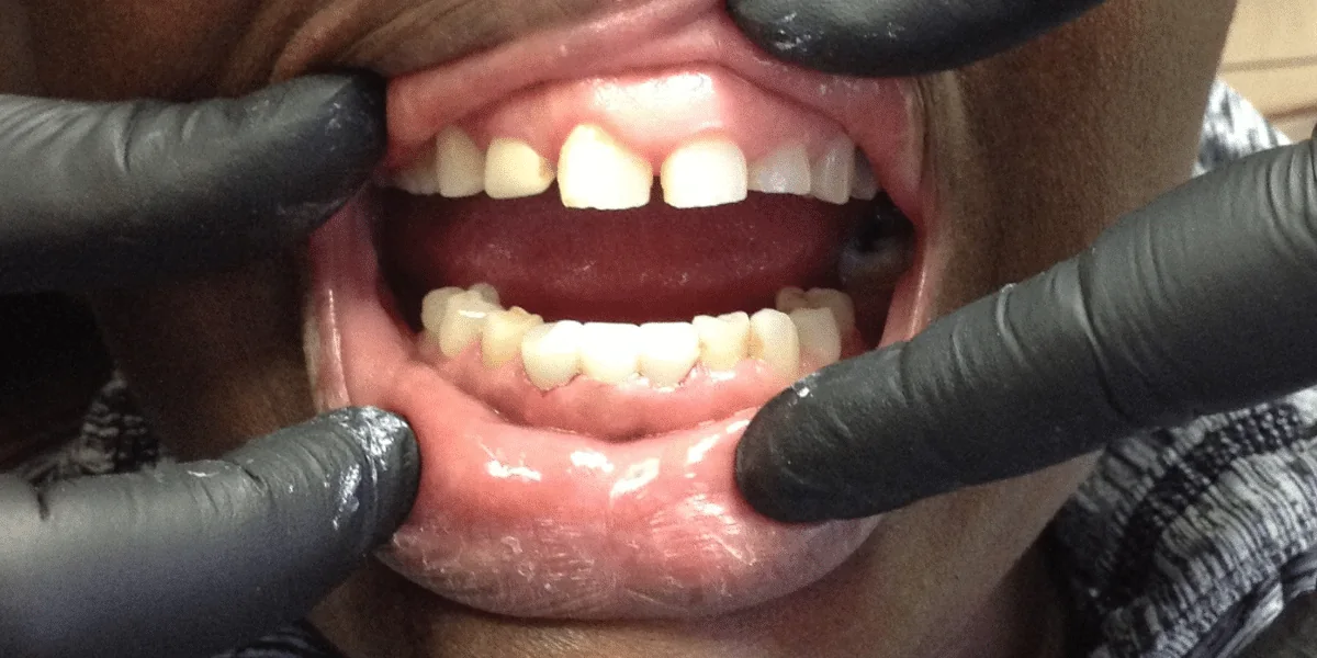 After photo for crown case 5 smile transformation