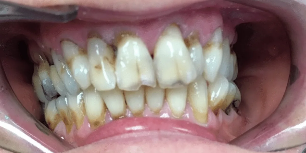 Before photo for crown case 4 smile transformation