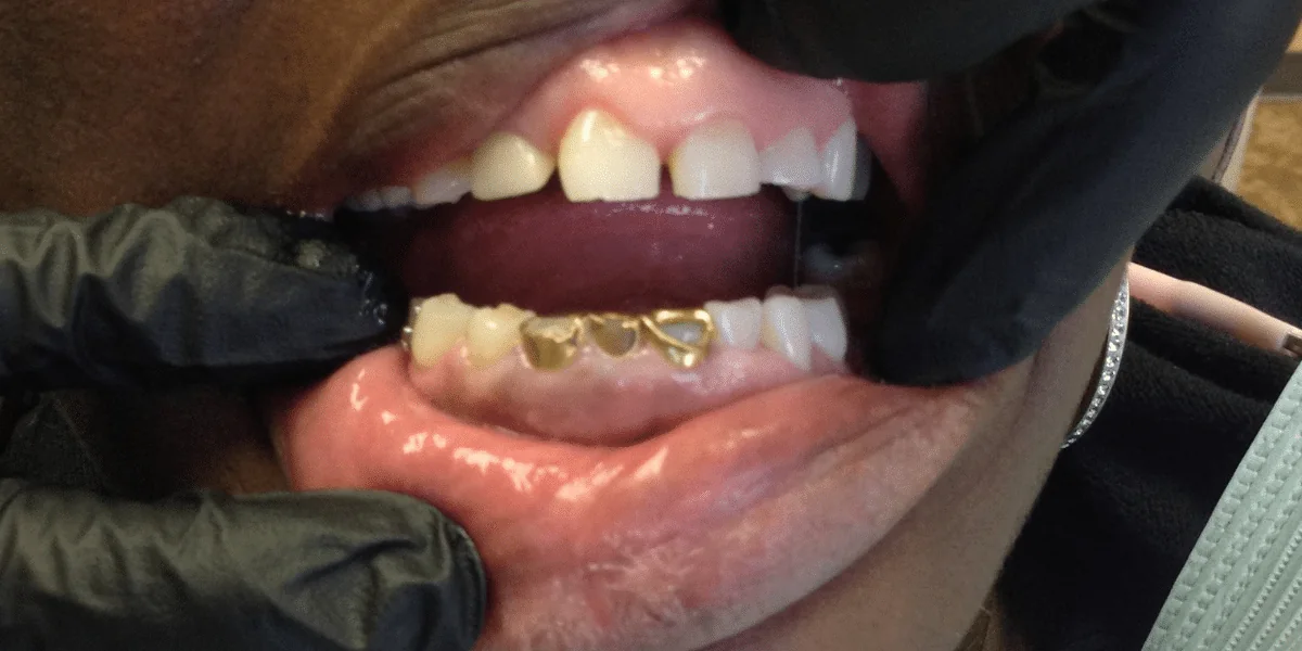 Before photo for crown case 5 smile transformation