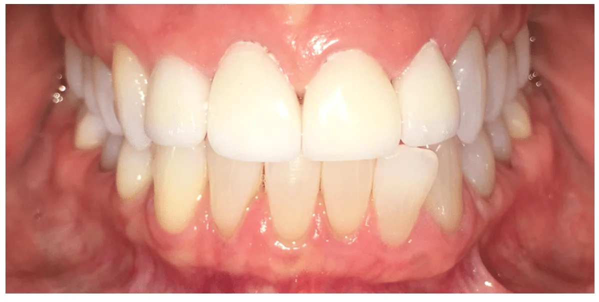 After photo for crown case 1 smile transformation