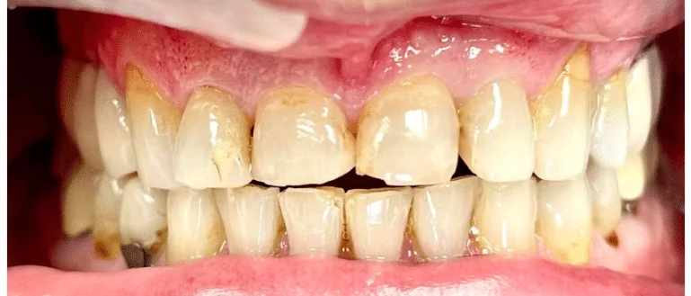 Before photo for crown case 2 smile transformation