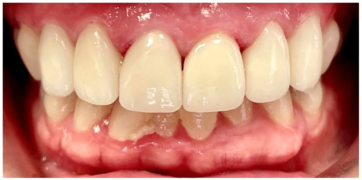 After photo for crown case 3 smile transformation